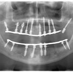 A fog implantátum bekerülésének szakaszai