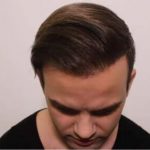 A hajbeültetés árak jelenleg ideálisak